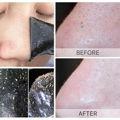 Unisex Blackhead Removal Mask